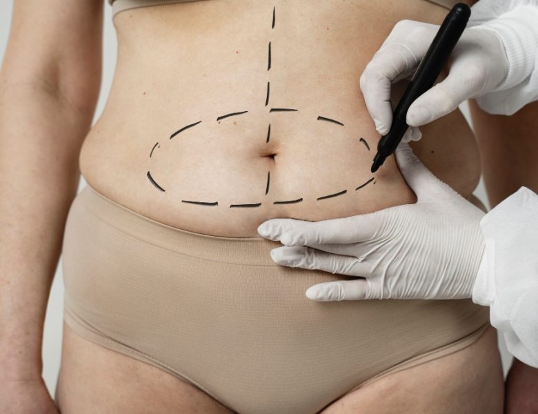 Le caratteristiche della liposuzione Roma