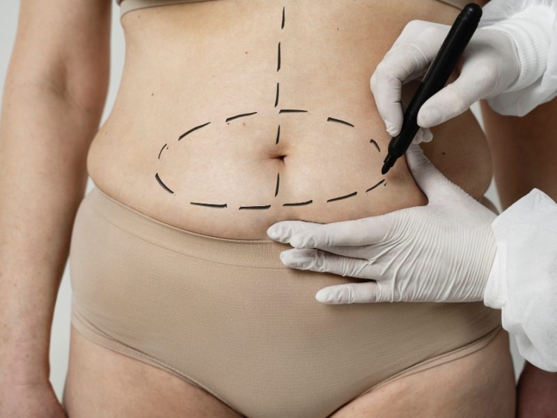 Le caratteristiche della liposuzione Roma