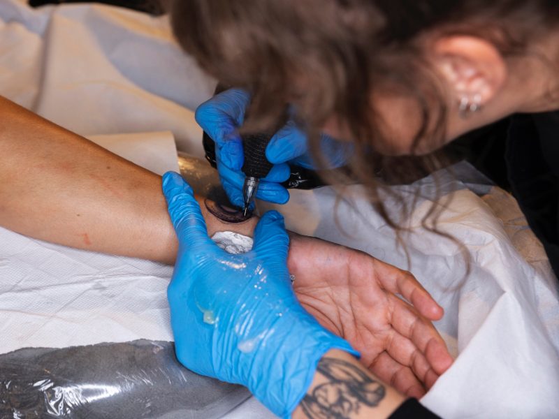Rimozione tatuaggi laser a Brescia: perché questo servizio è fondamentale